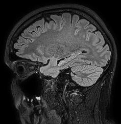 Cerebral arteriovenous malformation (Radiopaedia 74411-85654 Sagittal FLAIR 38).jpg