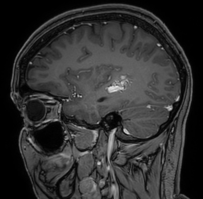Cerebral arteriovenous malformation (Radiopaedia 74411-85654 Sagittal T1 C+ 35).jpg