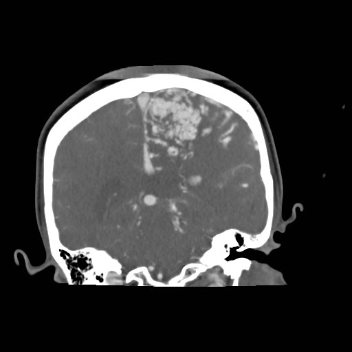 File:Cerebral arteriovenous malformation (Radiopaedia 79677-92888 B 27).jpg
