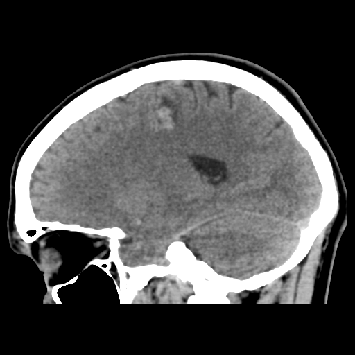 Cerebral arteriovenous malformation (Spetzler-Martin grade 2) (Radiopaedia 41262-44076 A 26).png