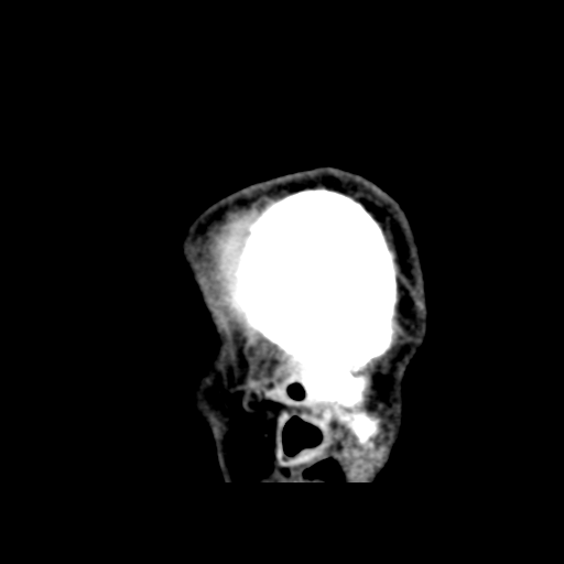 File:Cerebral arteriovenous malformation (Spetzler-Martin grade 2) (Radiopaedia 41262-44076 A 9).png