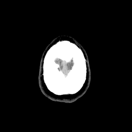 Cerebral arteriovenous malformation (Spetzler-Martin grade 2) (Radiopaedia 41262-44076 Axial non-contrast 53).png