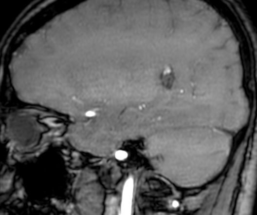 Cerebral arteriovenous malformation at posterior body of corpus callosum (Radiopaedia 74111-84925 J 116).jpg