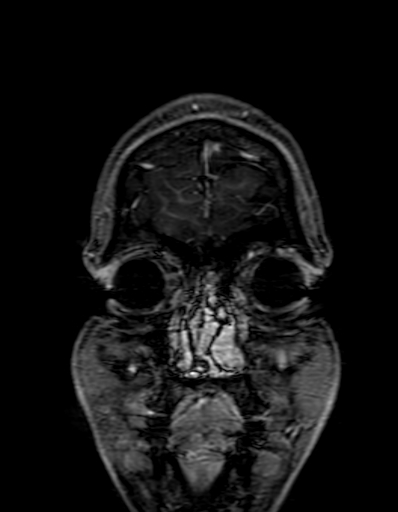 Cerebral arteriovenous malformation at posterior body of corpus callosum (Radiopaedia 74111-84925 K 17).jpg