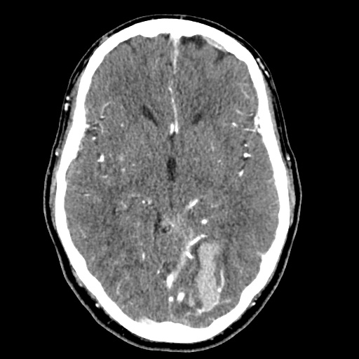 File:Cerebral arteriovenous malformation with lobar hemorrhage (Radiopaedia 35598-57216 A 27).jpg