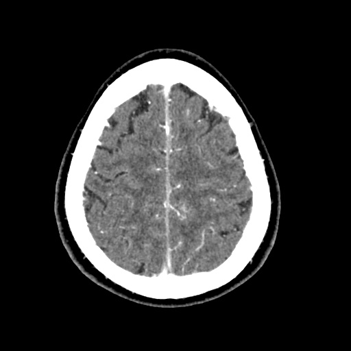 File:Cerebral arteriovenous malformation with lobar hemorrhage (Radiopaedia 35598-57216 A 51).jpg