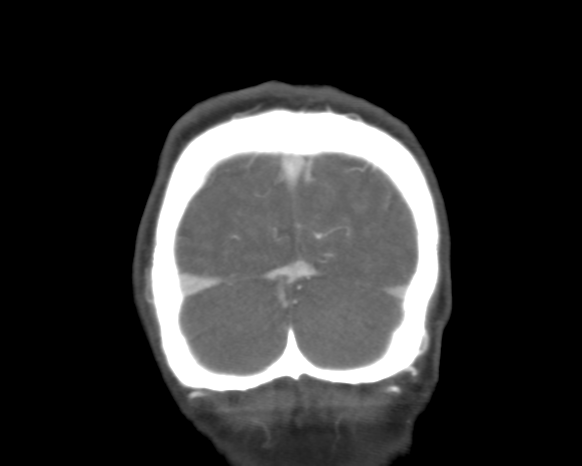 Cerebral arteriovenous malformation with lobar hemorrhage (Radiopaedia 44725-48511 A 52).png