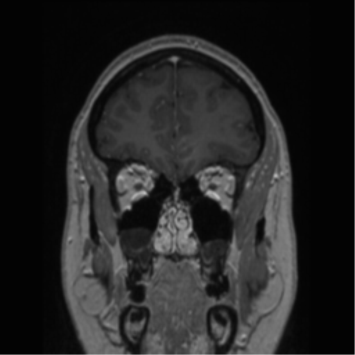 Cerebral cavernoma and development venous anomaly (Radiopaedia 37603-39482 Coronal T1 C+ 74).png