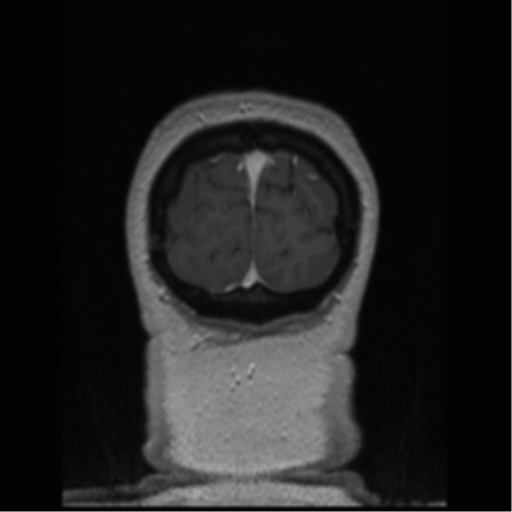 Cerebral cavernoma and development venous anomaly (Radiopaedia 37603-39482 Coronal T1 C+ 8).png
