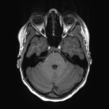 Cerebral cavernous venous malformation (Radiopaedia 70008-80021 Axial T1 19).jpg