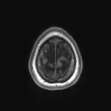 Cerebral cavernous venous malformation (Radiopaedia 70008-80021 Axial T1 90).jpg