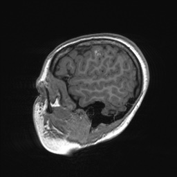 File:Cerebral cavernous venous malformation (Radiopaedia 70008-80021 Sagittal T1 12).jpg