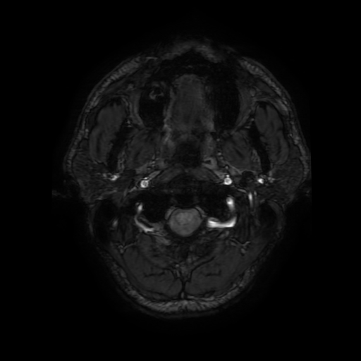 Cerebral cavernous venous malformation (Zabramski type II) (Radiopaedia 85511-101198 Axial SWI 3).jpg