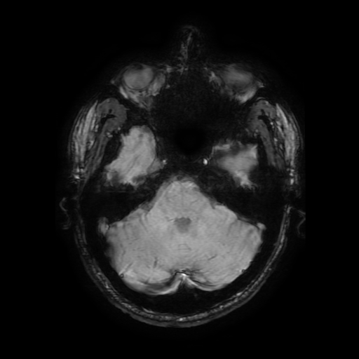 Cerebral cavernous venous malformation (Zabramski type II) (Radiopaedia 85511-101198 Axial SWI 41).jpg