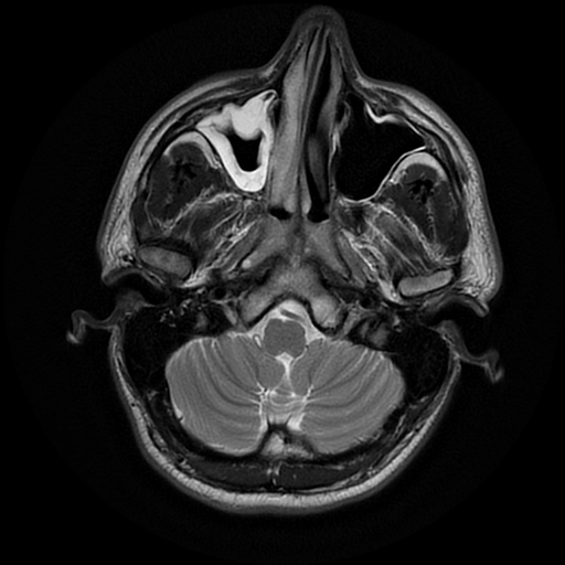 File:Cerebral cavernous venous malformation (Zabramski type II) (Radiopaedia 85511-101198 Axial T2 6).jpg
