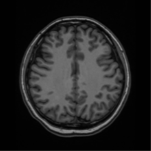 File:Cerebral cavernous venous malformations (Radiopaedia 48117-52946 Axial T1 32).png