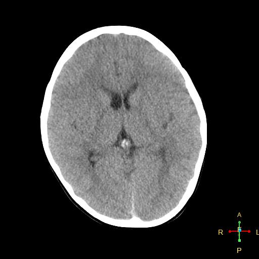 File:Cerebral contusion (Radiopaedia 48869-53911 Axial non-contrast 10).jpg