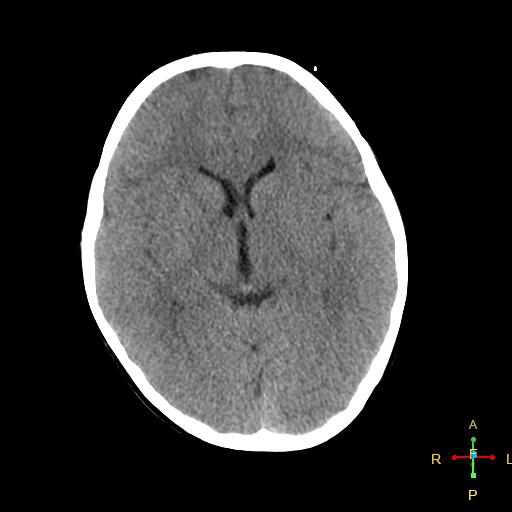 File:Cerebral contusion (Radiopaedia 48869-53911 Axial non-contrast 9).jpg