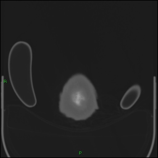 File:Cerebral contusions (Radiopaedia 33868-35039 Axial bone window 229).jpg