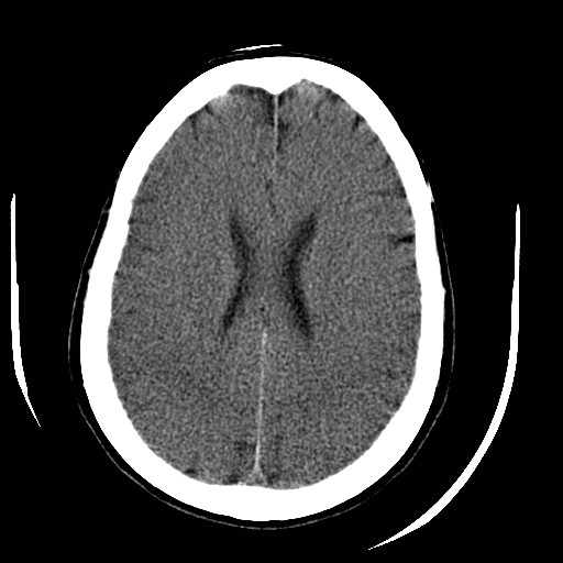 File:Cerebral edema (evolution in time) (Radiopaedia 19418-19440 non-contrast 64).jpg