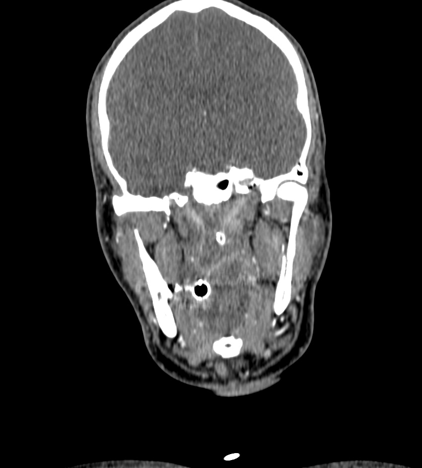 Cerebral edema in an overdose patient (Radiopaedia 72005-82539 B 34).jpg