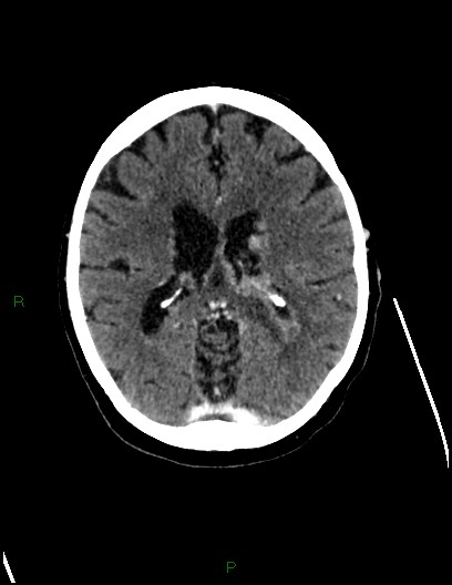 Cerebral metastases - ependymal and parenchymal (Radiopaedia 79877-93131 Axial C+ delayed 47).jpg