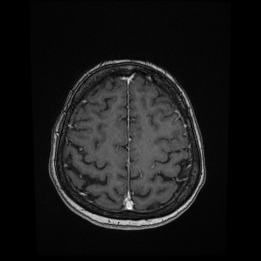 File:Cerebral metastases - melanoma (Radiopaedia 80972-94522 Axial T1 C+ 74).jpg