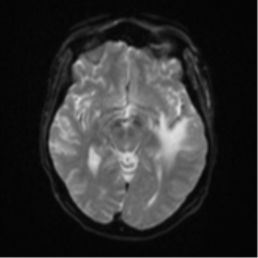 File:Cerebral metastasis (Radiopaedia 46744-51248 Axial DWI 12).png