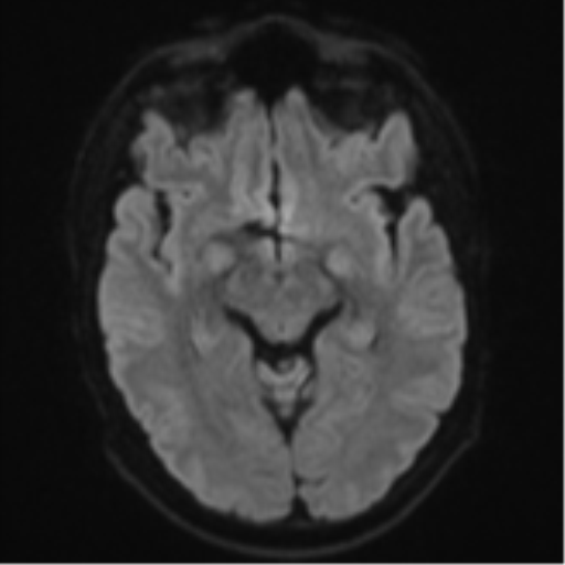 Cerebral metastasis - colorectal adenocarcinoma (Radiopaedia 50394-55765 Axial DWI 39).png