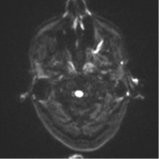 Cerebral metastasis - melanoma (Radiopaedia 54718-60954 Axial DWI 32).png