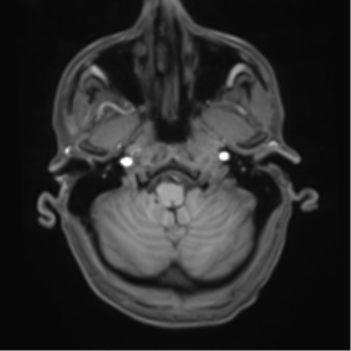 File:Cerebral metastasis - melanoma (Radiopaedia 54718-60954 Axial T1 10).png