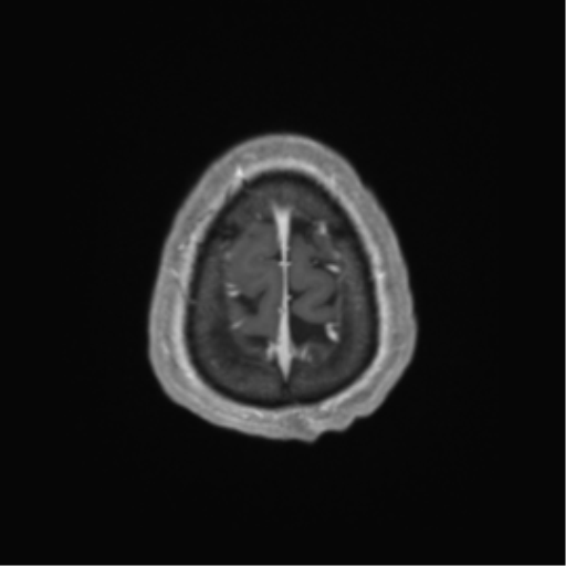 Cerebral metastasis to basal ganglia (Radiopaedia 81568-95413 Axial T1 C+ 70).png