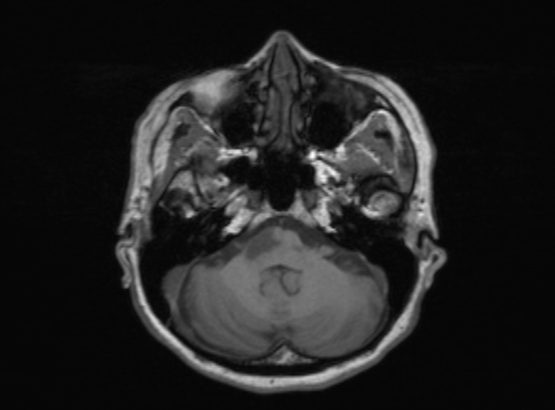 Cerebral ring enhancing lesions - cerebral metastases (Radiopaedia 44922-48817 Axial T1 306).jpg