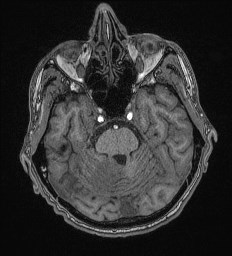 File:Cerebral toxoplasmosis (Radiopaedia 43956-47461 Axial T1 22).jpg
