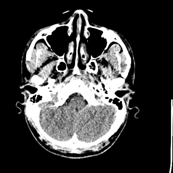 Cerebral toxoplasmosis (Radiopaedia 53993-60131 Axial non-contrast 15).jpg
