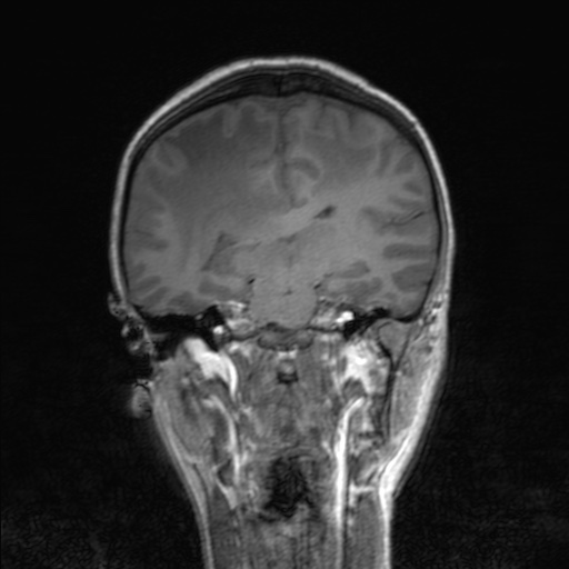 Cerebral tuberculosis with dural sinus invasion (Radiopaedia 60353-68090 Coronal T1 105).jpg