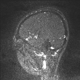 Cerebral tuberculosis with dural sinus invasion (Radiopaedia 60353-68090 Sagittal MRV 120).jpg