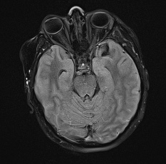 File:Cerebral venous infarction - hemorrhagic (Radiopaedia 81625-95505 Axial FLAIR 10).jpg
