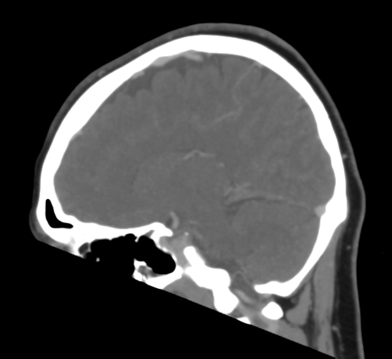 Cerebral venous infarction due to transverse sinus thrombosis (Radiopaedia 34688-36120 Sagittal CT venogram 32).png