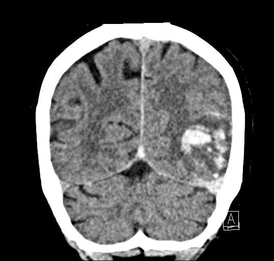 Cerebral venous infarction with hemorrhage (Radiopaedia 65343-74381 Coronal non-contrast 44).jpg