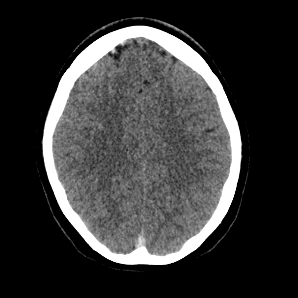 Cerebral venous sinus thrombosis (Radiopaedia 59224-66551 Axial non-contrast 30).jpg