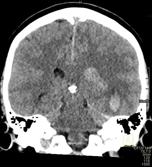 Cerebral venous sinus thrombosis (Radiopaedia 91329-108965 Coronal non-contrast 35).jpg