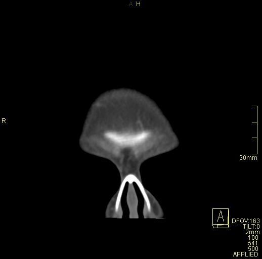 File:Cerebral venous sinus thrombosis (Radiopaedia 91329-108965 Coronal venogram 4).jpg