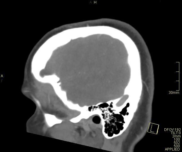 File:Cerebral venous sinus thrombosis (Radiopaedia 91329-108965 Sagittal venogram 12).jpg