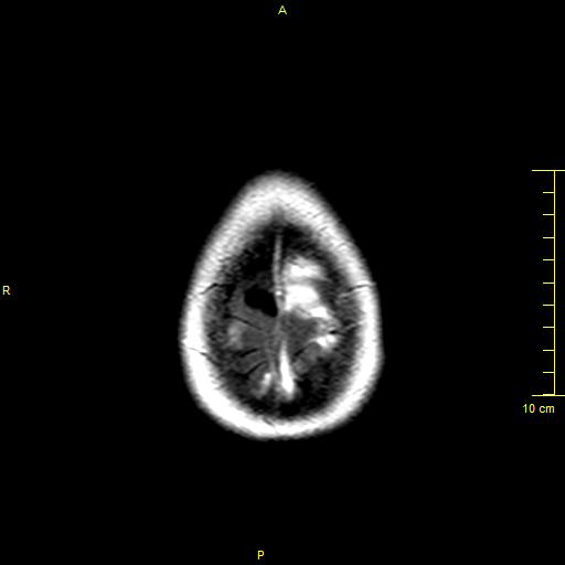 File:Cerebral venous thrombosis (Radiopaedia 23288-23351 Axial FLAIR 21).JPG