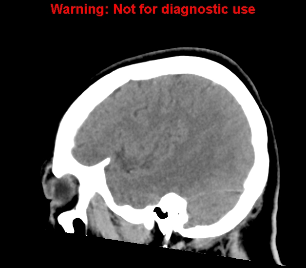 File:Cerebral venous thrombosis (Radiopaedia 37224-38992 B 24).jpg