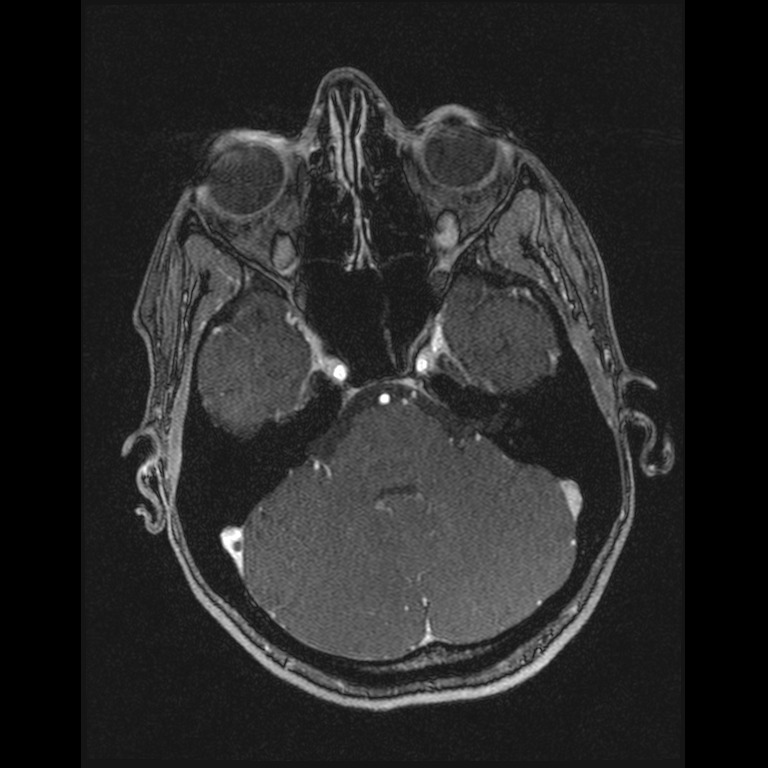 Cerebral venous thrombosis (Radiopaedia 45678-49854 Axial MRV 16).jpg