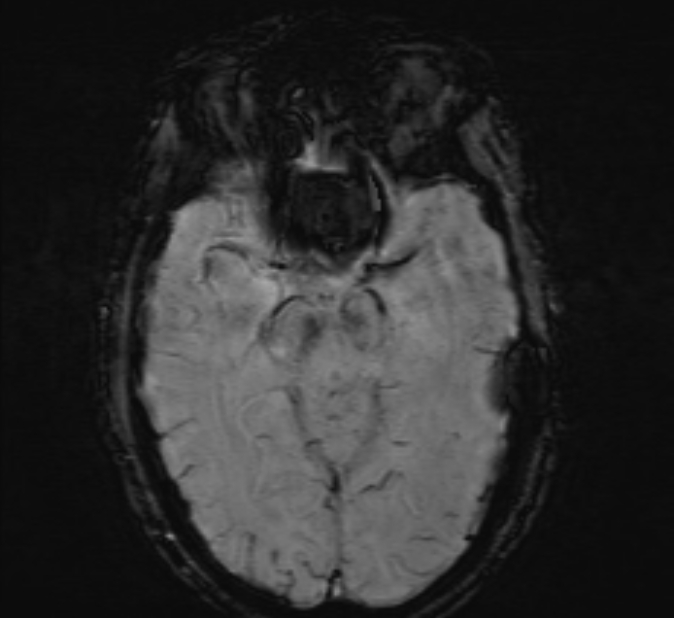 Cerebral venous thrombosis (Radiopaedia 71207-81504 Axial SWI 20).jpg