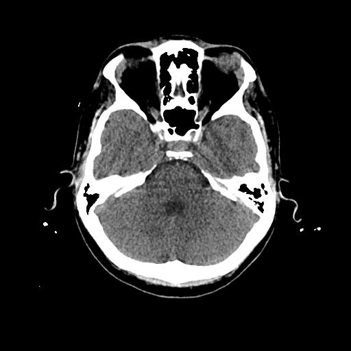 Cerebral venous thrombosis with venous hemorrhagic infarct (Radiopaedia 90354-107660 Axial non-contrast 16).jpg