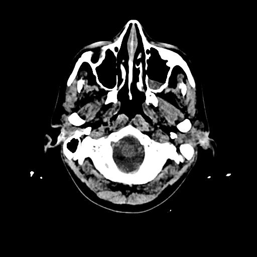 Cerebral venous thrombosis with venous hemorrhagic infarct (Radiopaedia 90354-107660 Axial non-contrast 6).jpg